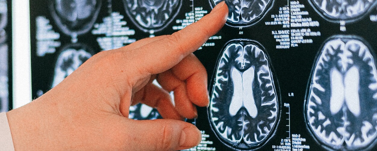 brain scans for memory loss